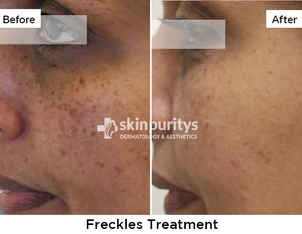Freckles results